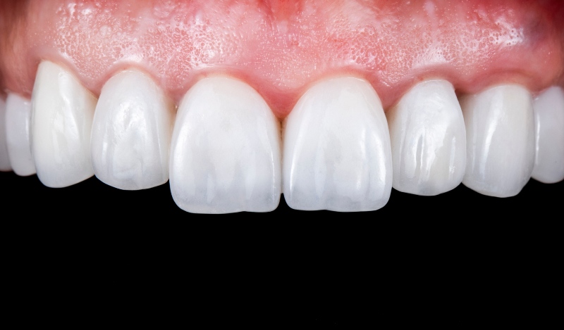 Close-up of shaped upper front teeth after enamel shaping in Southfield, MI