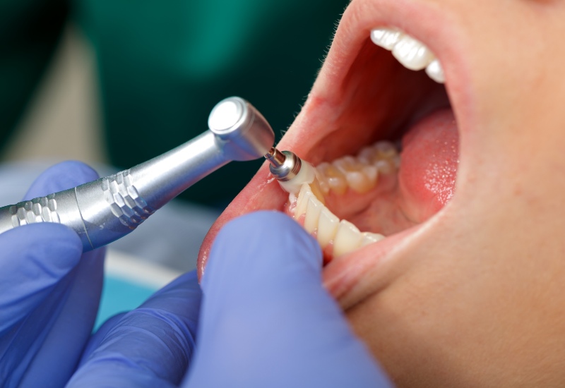 Dentist polishing teeth during cleaning in Southfield, MI