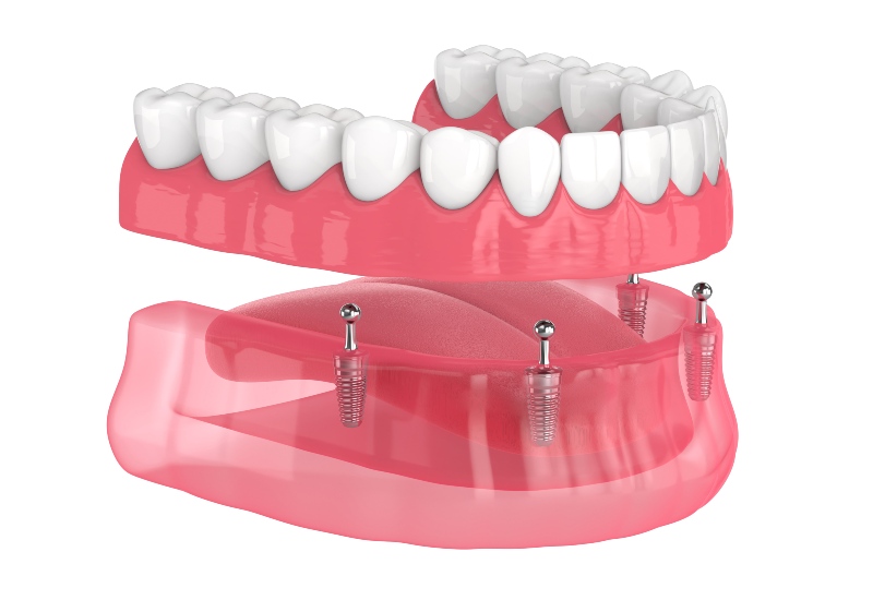 3D dental implant illustration with dentures in Southfield, MI