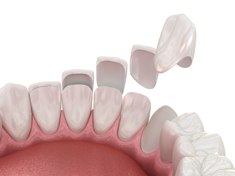 Dental veneers applied to lower teeth in Southfield, MI