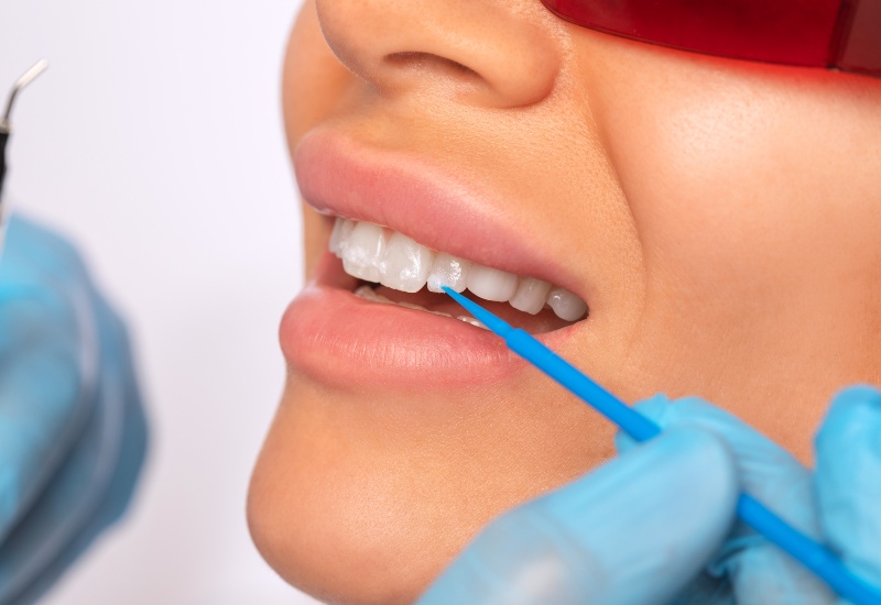 Dental enamel shaping procedure in Southfield, MI