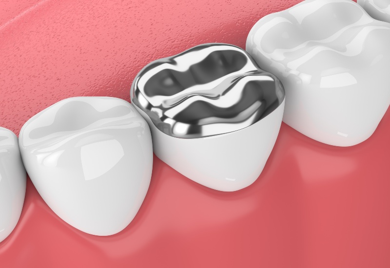 Dental crown on molar tooth in Southfield, MI