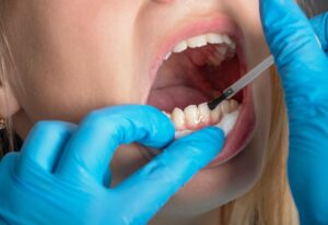 Tooth enamel protection procedure performed with precision tools in Southfield, MI